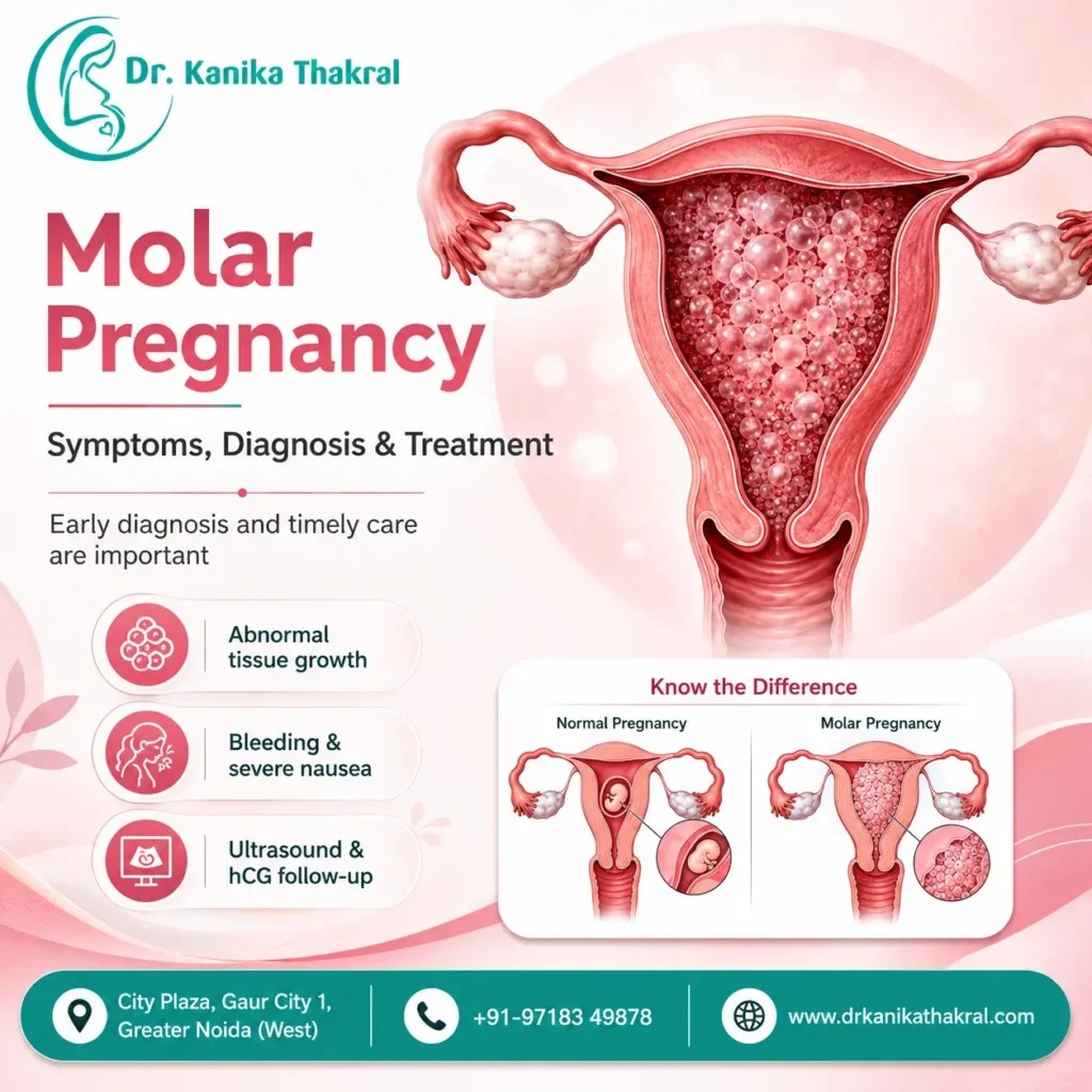 Molar Pregnancy: Symptoms, Diagnosis and Treatment in Gaur City